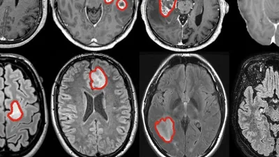 MRI scans with highlighted areas